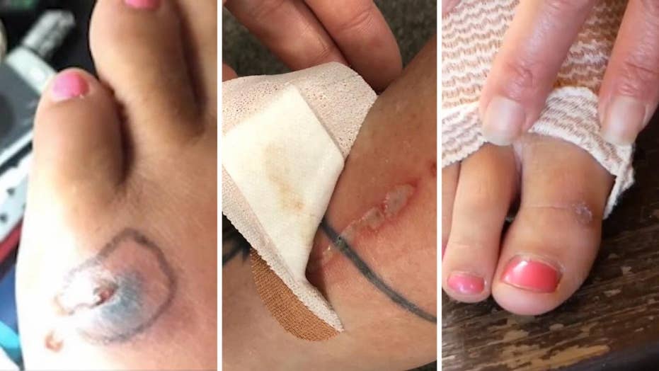 Florida Man Infected With Flesh Eating Bacteria After Being Bitten By Florida Man Infected With Flesh Eating Bacteria After Being Bitten By